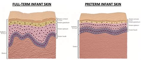 gelatenous skin premature baby|Premature infant skin barrier maturation: status at full.
